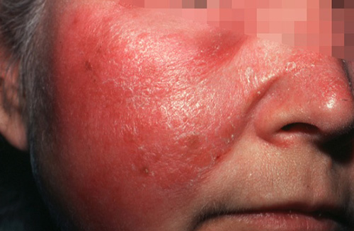Наименование заболевания произошло от французского rouge, что означает «красный». И действительно, недуг проявляется отеком красного цвета на лице, который отделен от здоровой кожи заметно приподнятым краем.