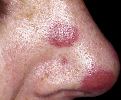 Появление красных пятен на коже может сигнализировать о развитии онкологического заболевания