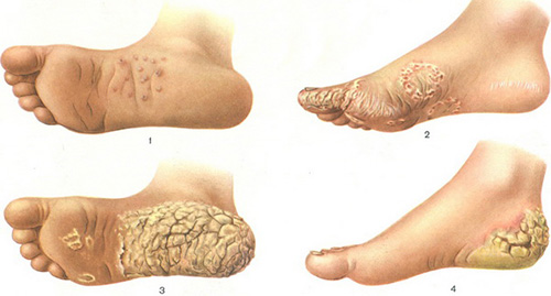 Гиперкератоз стоп часто развивается из-за ношения неудобной обуви. У таких пациентов наблюдается огрубение кожи, появление трещин, мозолей и натоптышей.