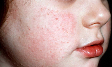 Пример гиперкератоза кожи у ребенка. Данная форма заболевания связана с гормональным сбоем в работе организма либо с переохлаждением кожных покровов.