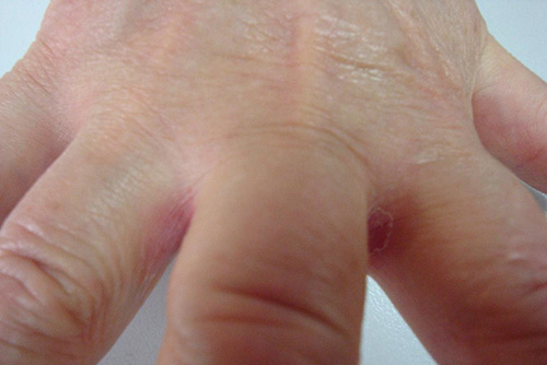 Межфаланговый кандидоз с переходом на кожу пальцев