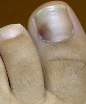 Внешний вид – появление черного или темно-коричневого пятна под ногтем с постепенным увеличением в размерах