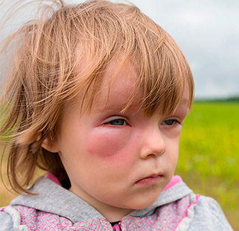 Статистика детской аллергологии утверждает, что от заболевания страдают 2% детей, причем девочки составляют большую часть