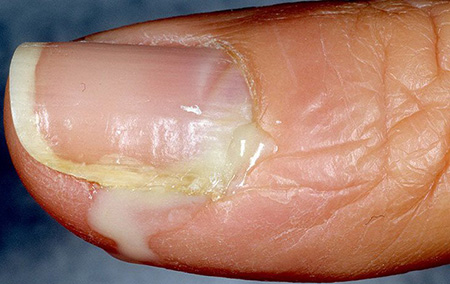Поражение ногтевой фаланги стрептококковым импетиго с образованием подковообразного нагноения