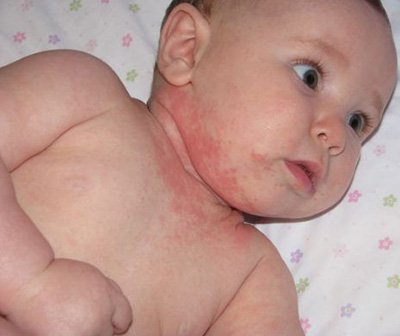 Новорожденные дети заболевают пузырчаткой на 3-10 день после рождения