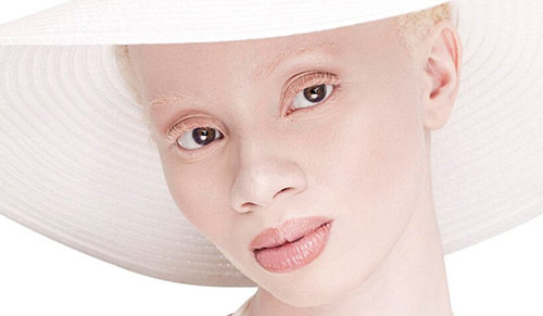 При альбинизме у пациентов наблюдается полная потеря пигмента кожными покровами
