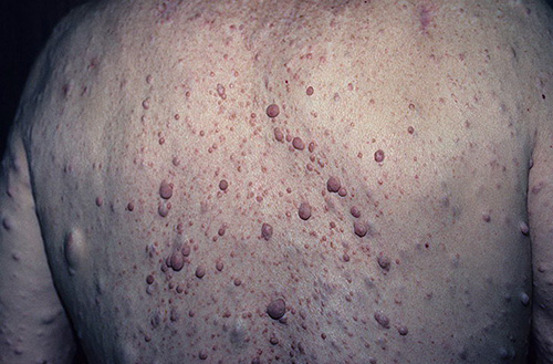Множественные нейрофибромы на коже спины