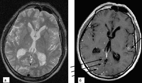 МРТ множественных опухолевых образований головного мозга. А - без контраста (очаги поражения плохо визуализируются), Б – четкое изображение после введения контраста.