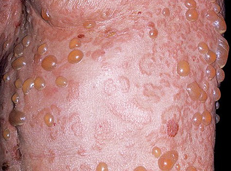 Пузыри распространяются по всей поверхности кожи, заполнены серозным содержимым. Характерен положительный симптом Никольского (при надавливании на пузырь его площадь увеличивается за счет отторжения кожи по периферии).