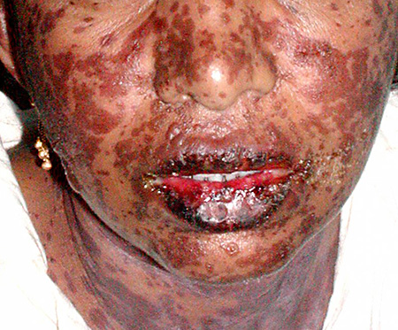 После отторжения поверхностного слоя кожи губ на его месте образуются твердые, темные большие корочки, доставляющие дискомфорт больному, затрудняющие его питание