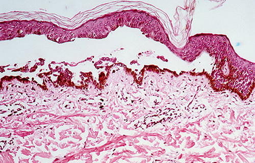 При гистологическом исследовании биопсийного материала обнаруживается некроз верхнего слоя эпидермиса, а также его отслоение от нижележащей базальной мембраны. Глубокие слои кожи отечны, с большим количеством иммунных комплексов.