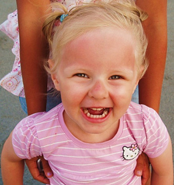 При повреждении кожи лица ребенок может получить и ожог глаз