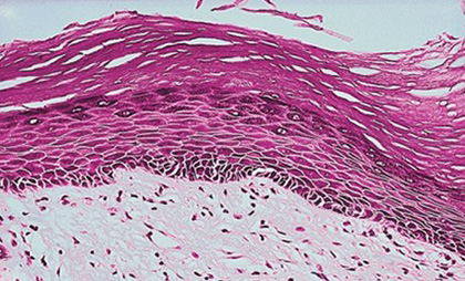 При изучении гистологического строения отмечаются участки гиперкератоза - чрезмерного утолщения верхнего слоя слизистой