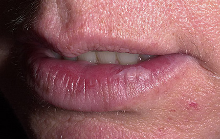 При локализации процесса на губе, особенно в уголке рта, возможно покраснение слизистой на границе с очагом поражения