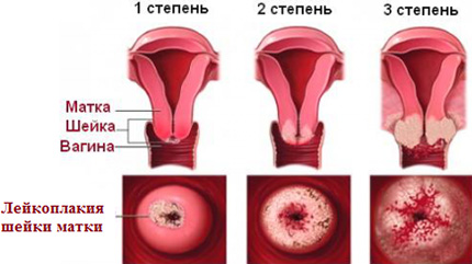 Внешний вид шейки матки в зависимости от стадии лейкоплакии