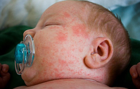 К лечению лица у младенца следует подходить особенно осторожно, так как можно спровоцировать ожог нежной кожи