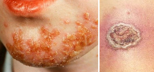 Поверхностное поражение кожи – импетиго (слева) и глубокое – эктима (справа)