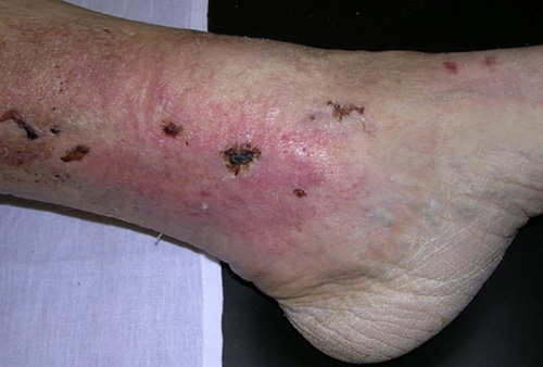 Согласно медицинским определениям, трофическим принято называть долго не заживающий кожный дефект