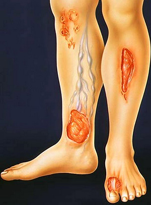 Гнойно-воспалительный процесс вовлекает в зону поражения, кроме кожного покрова, мышцы и кости