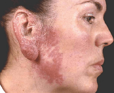 Такие повреждения кожи не только портят внешний вид человека, но и могут спровоцировать серьезные осложнения