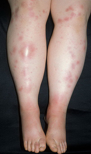 На первом этапе развития узловатой эритемы на ногах появляются узлы красного цвета, они болезненные