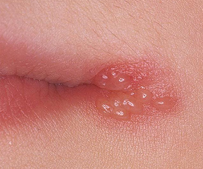 Проявление герпеса около рта – явление, знакомое многим. Оно требует лечения.