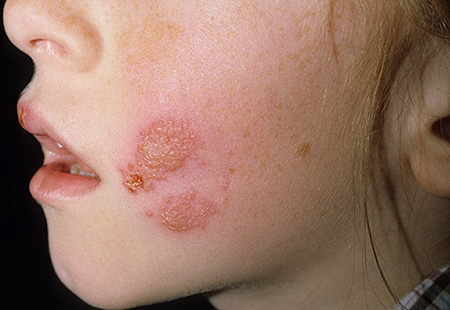 Вирусные заболевания кожи не только являются косметическим дефектом, но и чреваты различными осложнениями