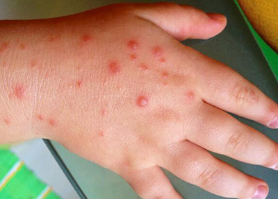 Образование вирусной пузырчатки на кисти рук врачи диагностируют чаще всего у детей