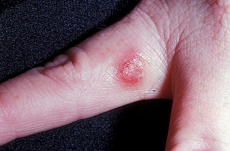 Вариант проявления вирусного пустулезного дерматита на пальцах рук