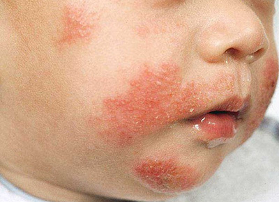 Аллергическая форма экземы характеризуется ярким покраснением кожи, отеком и множественным высыпанием пузырьков, вскрытие которых приводит к развитию мокнущих эрозий