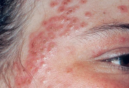 Согласно статистике, данное заболевание наблюдается в 30-40% случаев всех кожных патологий