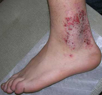 Во время болезни пораженные сегменты кожи уплотняются, кожный рисунок усиливается по мере развития воспалительного процесса