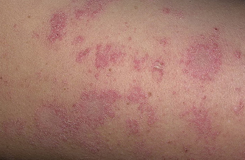Хроническая болезнь, проявляющаяся шелушащимися и мокнущими красными пятнами, может поражать кожу человека независимо от возраста