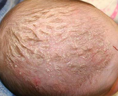 Себорейная экзема на волосистой части головы ребенка