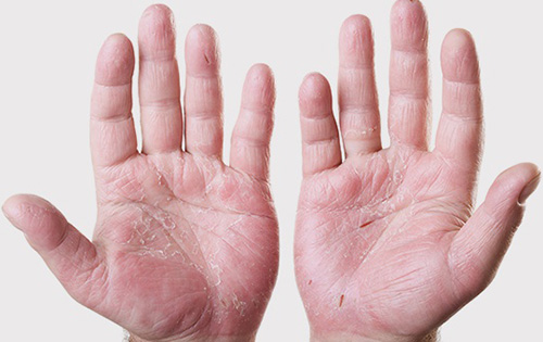 Хроническая экзема может проявляться на разных участках тела, однако чаще всего страдают кисти рук