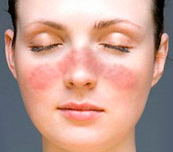 Проблемы с кожей особенно неприятны, если возникают на лице