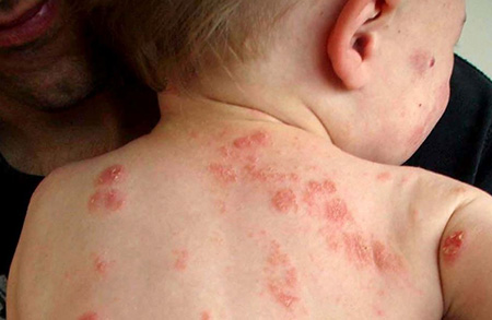 Микробная экзема на спине у ребенка относится к редким видам поражения