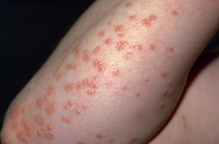 Папулезная стадия развития экзематозного дерматита характеризуется образованием четко выраженных ярко-красных пузырьков