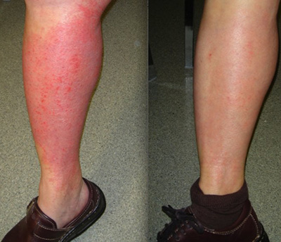 Результаты комплексного лечения микробной экземы на ногах в течение семи дней