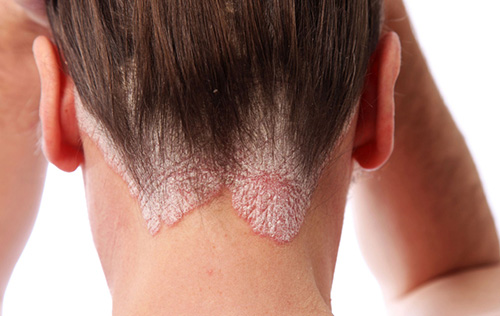 Характерный симптом себорейной экземы. Очаги поражения локализованы в нижней части роста волос.