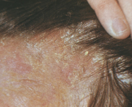 Симптомы себорейной экземы головы. Дерматоз проявляется серо-белыми чешуйками, струпьями в волосистой части головы.