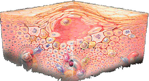 При развитии мокнущей экземы зачастую поражаются сосуды, расположенные в области повреждения кожи
