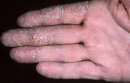 Руки наиболее часто подвержены заболеванию экземой