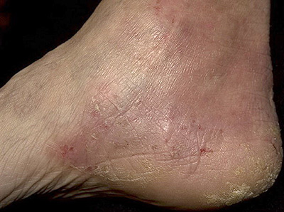 Даже очень сухая кожа ног благодаря лечению постепенно станет мягкой и здоровой