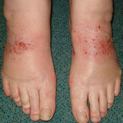 Повышенное давление в сосудах ног ведет к набуханию наружного слоя кожи и появлению нарушений эпидермиса