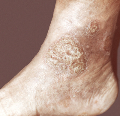 При переходе болезни в хроническую фазу появляются симптомы склероза наружного слоя кожи