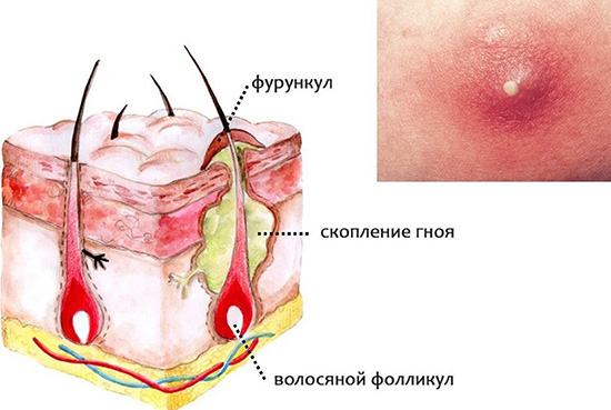 Фурункул - это воспаление не только волосяного фолликула, но и сальной железы, и окружающих тканей