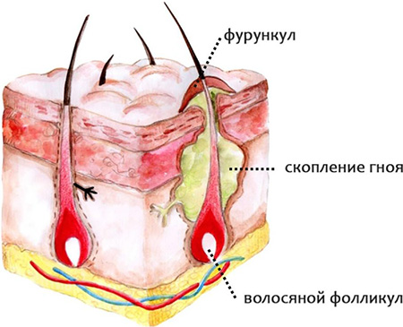 Фурункул - воспаление волосяного фолликула с последующим скоплением гноя в окружающих тканях