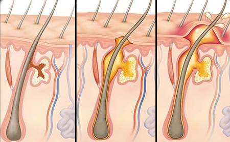 Три стадии развития чирея: 1 - появление инфекционного очага; 2 - образование стержня с гнойным содержимым; 3 - вскрытие фурункула