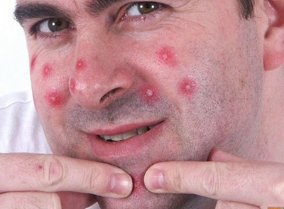 Выдавливание прыщиков на лице – частая причина распространения фурункулов, развития фурункулеза